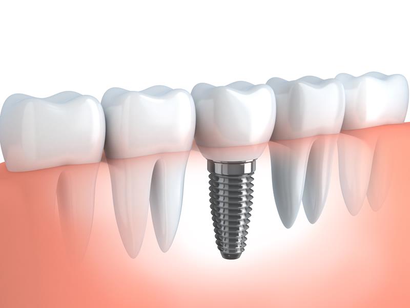 Dental Implants  Manchester, NH 