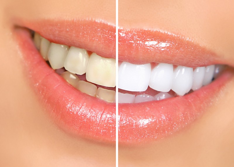 Teeth Whitening Manchester, NH